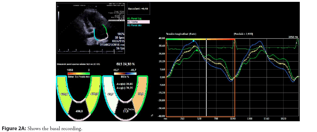 interventional-cardiology-basal