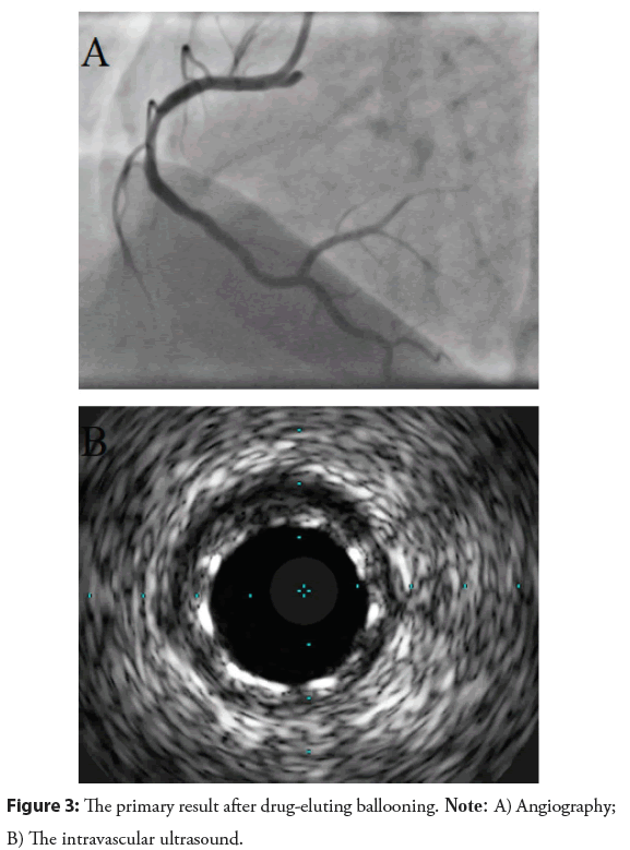 interventional-cardiology-eluting