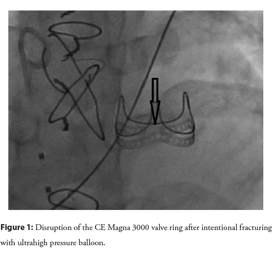 interventional-cardiology-fracturing