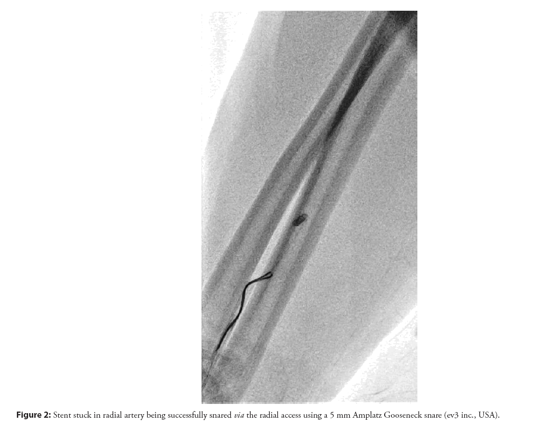 interventional-cardiology-gooseneck