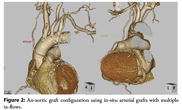 interventional-cardiology-grafts