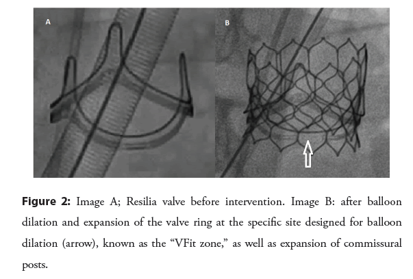 interventional-cardiology-intervention