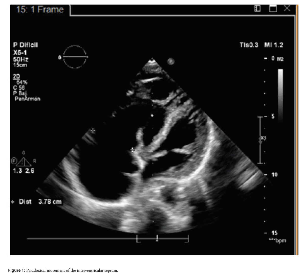 interventional-cardiology-interventricular