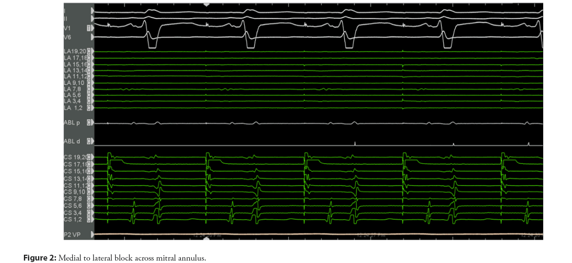 interventional-cardiology-mitral