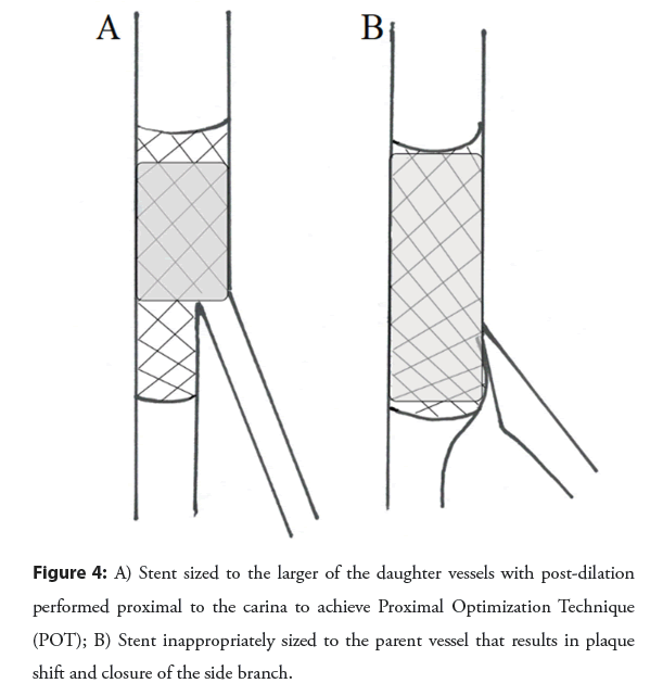 interventional-cardiology-proximal