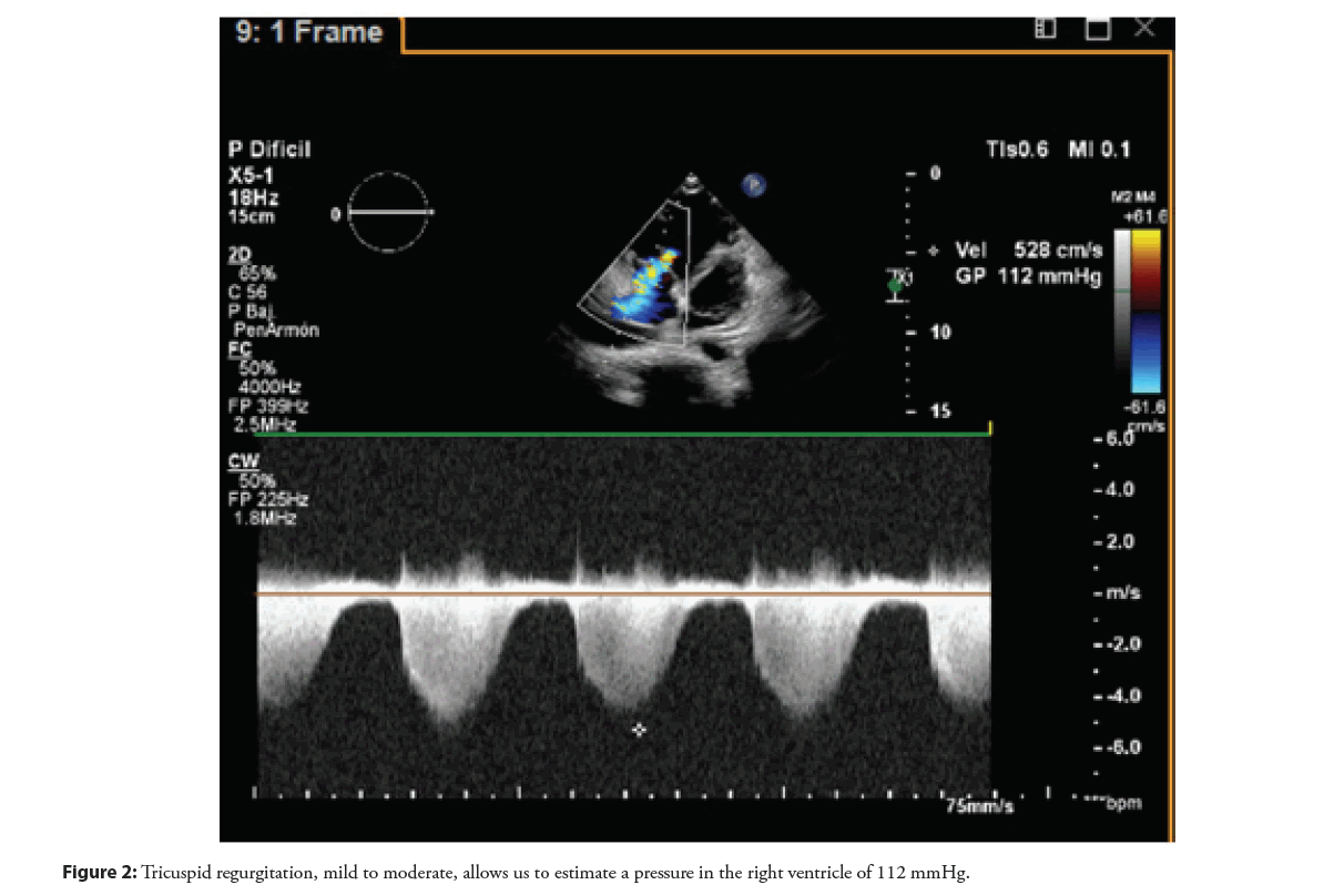 interventional-cardiology-regurgitation