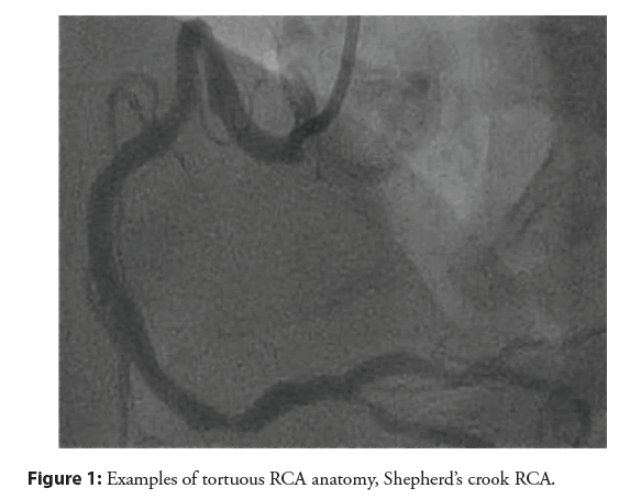 interventional-cardiology-tortuous