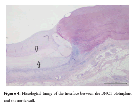 interventional-cardiology-bioimplant