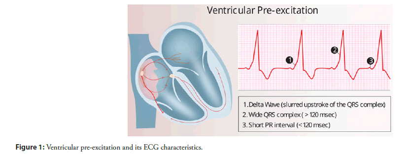 interventional-cardiology-excitation