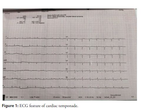 interventional-cardiology-temponade