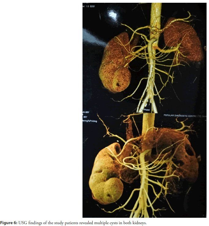 interventional-cysts