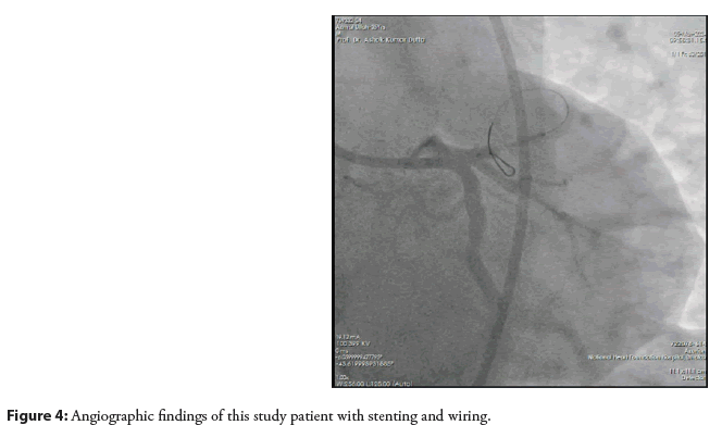 interventional-stenting