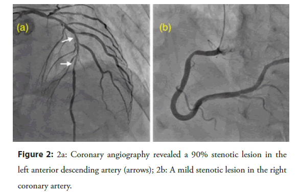 Interventional-Cardiology-angiography