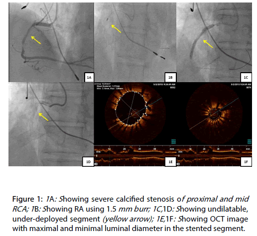 Interventional-Cardiology-calcified