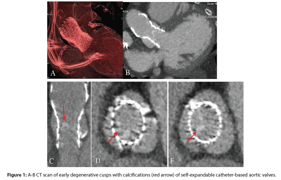 Interventional-Cardiology-degenerative