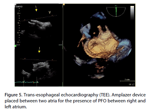 Interventional-Cardiology-device