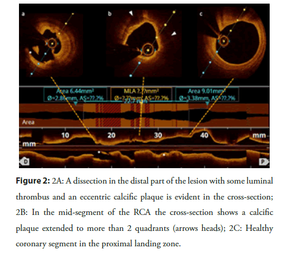 Interventional-Cardiology-distal