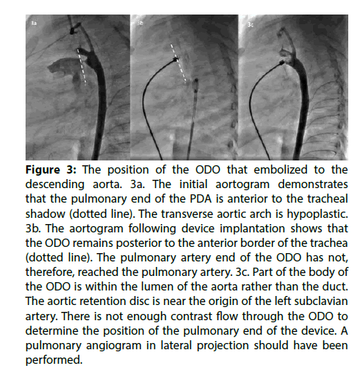 Interventional-Cardiology-embolized