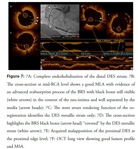 Interventional-Cardiology-endothelialization