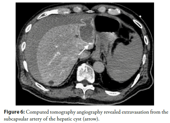 Interventional-Cardiology-extravasation