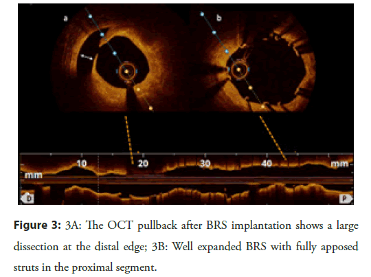 Interventional-Cardiology-implantation