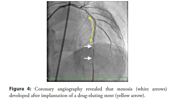 Interventional-Cardiology-implantation