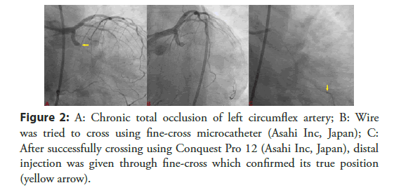 Interventional-Cardiology-occlusion