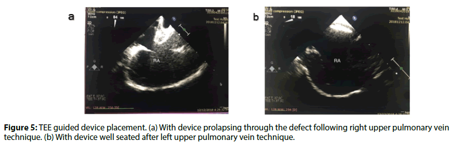 Interventional-Cardiology-prolapsing