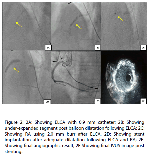 Interventional-Cardiology-segment