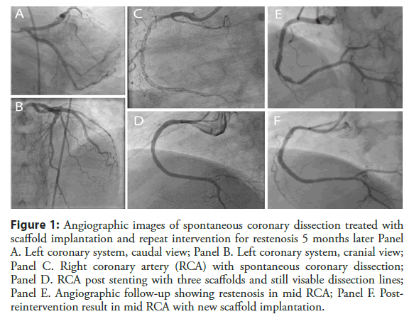 Interventional-Cardiology-spontaneous