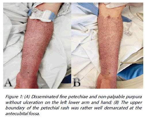 Interventional-Cardiology-ulceration