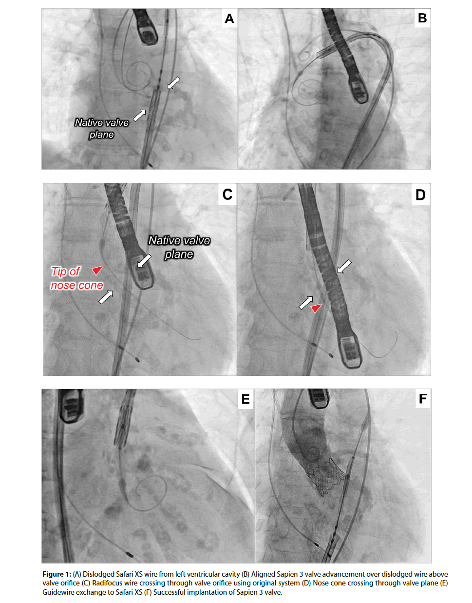 Interventional-Cardiology-ventricular