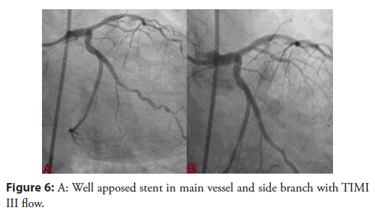 Interventional-Cardiology-vessel