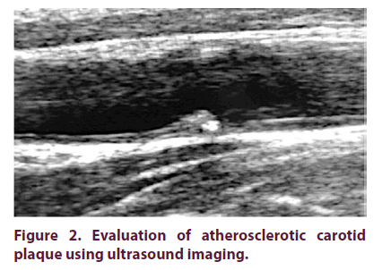 article-clinical-rheumatology-atherosclerotic-carotid