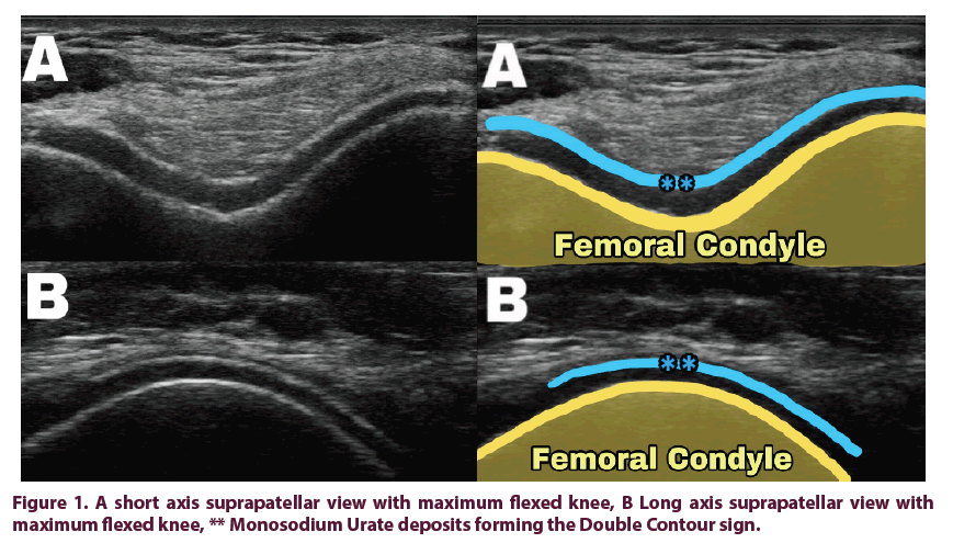 article-clinical-rheumatology-axis-suprapatellar