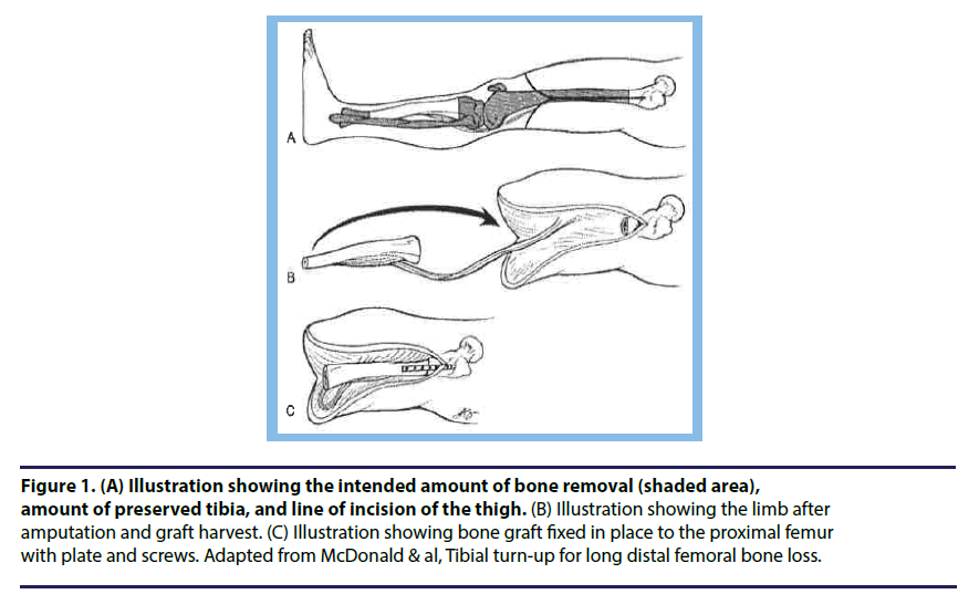 chronic-diseases-bone-removal