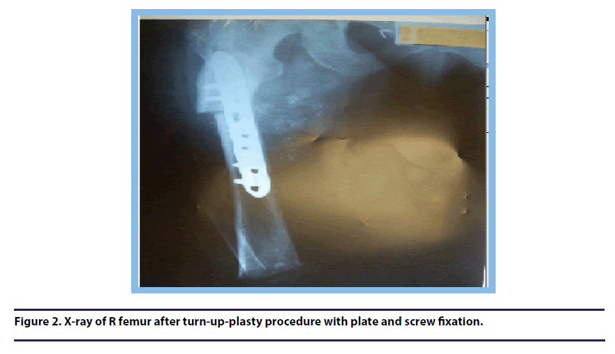 chronic-diseases-screw-fixation