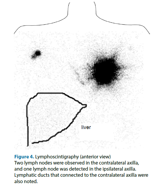 clinical-investigation-Lymphoscintigraphy