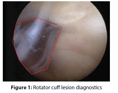 clinical-investigation-Rotator-cuff
