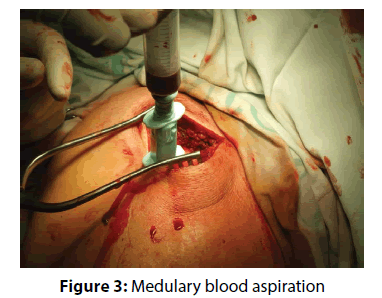 clinical-investigation-blood-aspiration