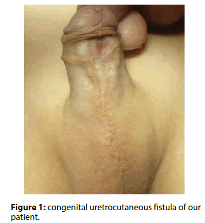 clinical-investigation-congenital-uretrocutaneous