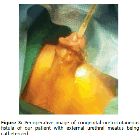 clinical-investigation-congenital-uretrocutaneous
