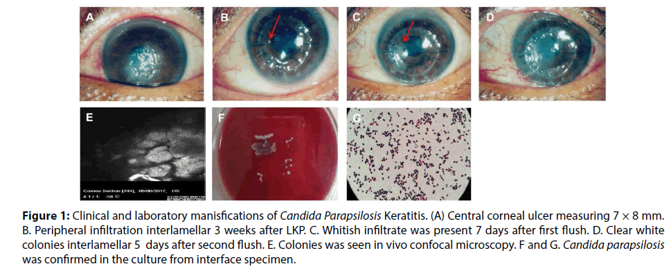 clinical-investigation-corneal-ulcer