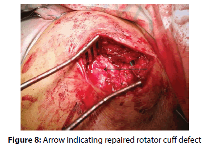 clinical-investigation-rotator-cuff