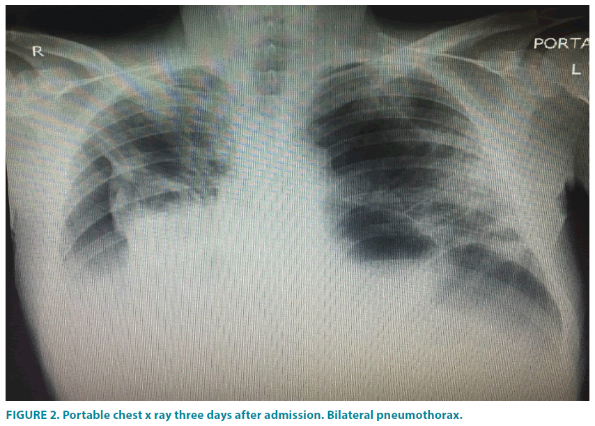 clinical-practice-Bilateral-pneumothorax