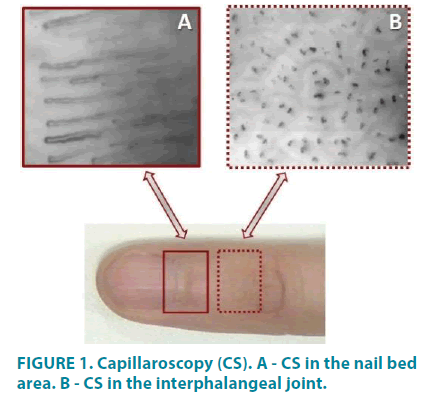 clinical-practice-Capillaroscopy