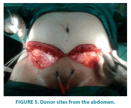 clinical-practice-Donor-sites-abdomen
