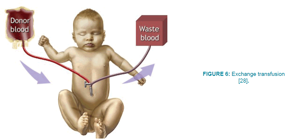 clinical-practice-Exchange-transfusion