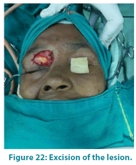 clinical-practice-Excision-lesion