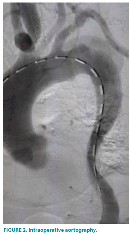 clinical-practice-Intraoperative-aortography